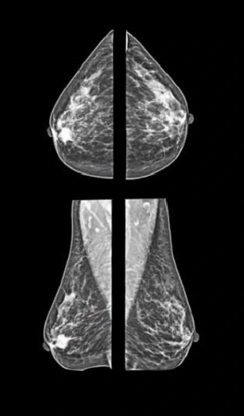 Mastógrafo Navigator Platinum