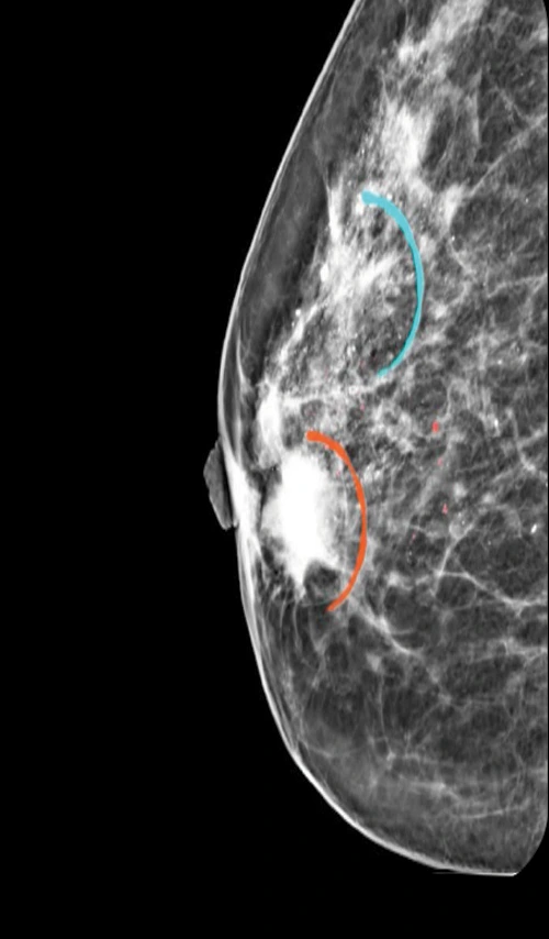 Mastógrafo Navigator Platinum